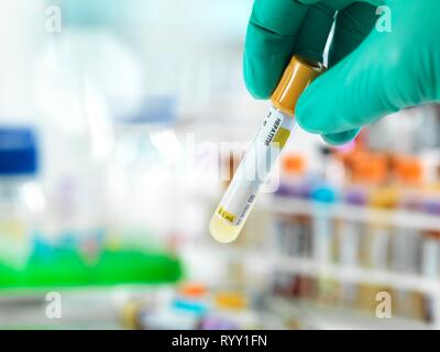 Technician holding a hepatitis sample with other human medical samples in the background. Stock Photo