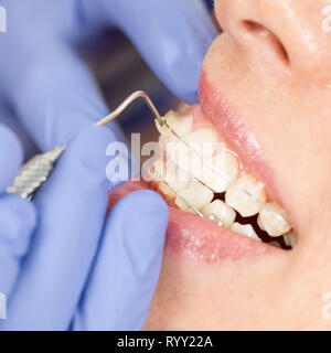 Orthodontist tightening braces. Stock Photo