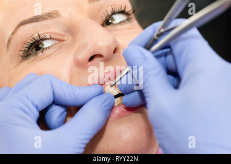 Orthodontist tightening braces. Stock Photo