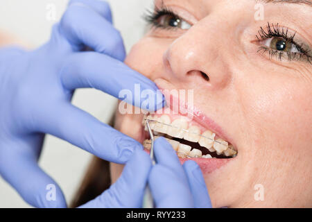Orthodontist tightening braces. Stock Photo
