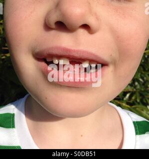 Boy with front tooth missing Stock Photo