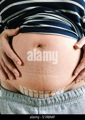 Close up of a woman's belly with stitches after delivering a baby via cesarean section. Stock Photo