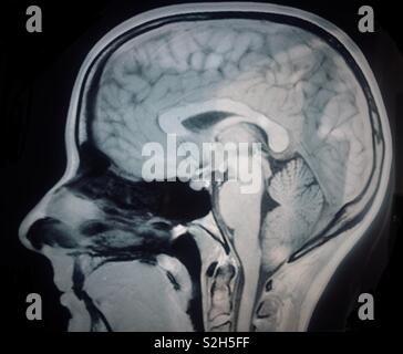 Saggital brain MRI scan of healthy young female Stock Photo