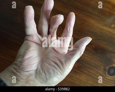 Dupuytren's contracture is a hand deformity Stock Photo - Alamy