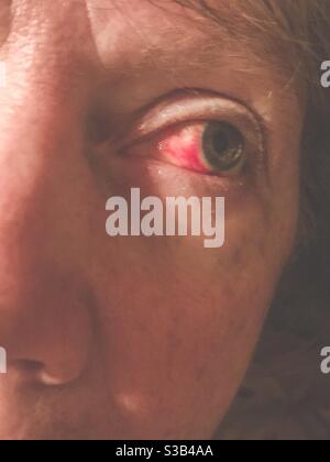 Broken blood vessel in eye of middle aged woman Stock Photo