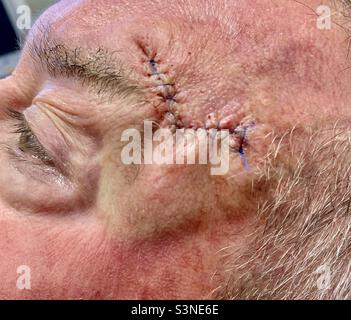 Stitches from skin cancer on man’s face. Stock Photo