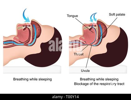 Snoring medical vector illustration with description on white background Stock Vector