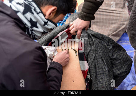 March 21, 2019 - Srinagar, Jammu and Kashmir, India - A Kashmiri patient seen with leeches on his back during the leech treatment.A traditional health worker uses leeches to suck impure blood as part of a treatment at Hazratbal on the banks of the Dal Lake on the outskirts of Srinagar Summer capital of Indian administered Kashmir. Every year traditional health workers in Kashmir use leeches to treat people for itchy, painful lumps that develop on the skin called chilblains acquired during winter. Thousands of patients suffering from various skin problems receives leech treatment at Hazratbal Stock Photo