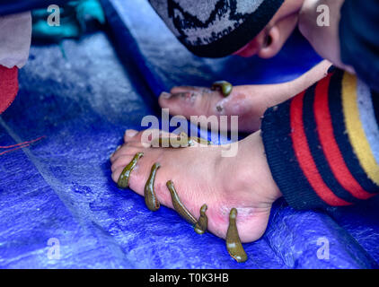 March 21, 2019 - Srinagar, Jammu and Kashmir, India - A young Kashmiri patient seen with leeches on his feet during the leech treatment.A traditional health worker uses leeches to suck impure blood as part of a treatment at Hazratbal on the banks of the Dal Lake on the outskirts of Srinagar Summer capital of Indian administered Kashmir. Every year traditional health workers in Kashmir use leeches to treat people for itchy, painful lumps that develop on the skin called chilblains acquired during winter. Thousands of patients suffering from various skin problems receives leech treatment at Hazr Stock Photo
