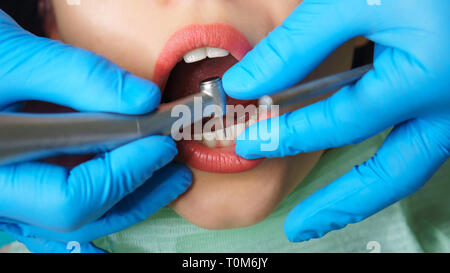 Dentist treats woman's teeth. Young girl with open mouth. White teeth. Dentist's hands with raising tip. Close-up. Dental clinic. Stock Photo