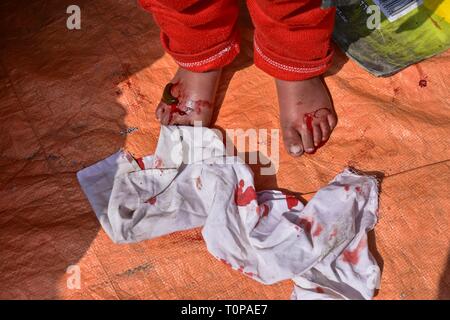 March 21, 2019 - Srinagar, J&K, India - A patient seen bleeding during the leech therapy..Every year traditional health workers in Kashmir use leeches to treat people suffering from skin diseases, arthritis, chronic headaches and sinusitis on Nowruz, which marks the first day of spring and the beginning of the year in the Persian calendar. (Credit Image: © Saqib Majeed/SOPA Images via ZUMA Wire) Stock Photo