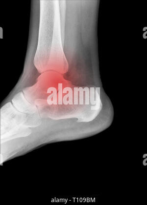 X-ray medical picture - Human foot with red symbol of painful place Stock Photo