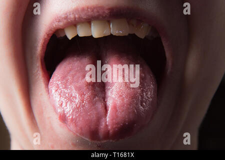 Close-up of oral thrush (candidiasis, white) on the palate of the mouth ...