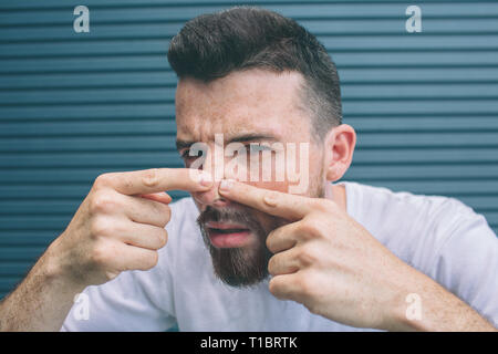 Guy is squeezing pimples on his nose. He is looking close on camera. Isolated on striped and blue background. Stock Photo