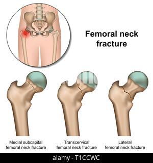 Femoral neck fractures medical vector illustration on white background Stock Vector