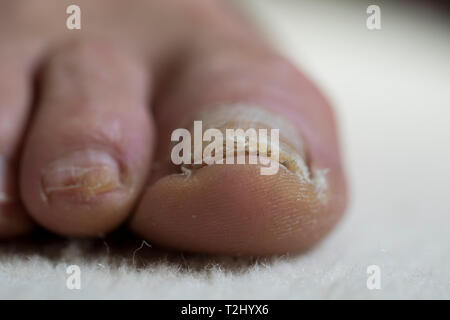 Feet close up with toenail damage on big toe of an older man. Medical treatment for bacterial foot fungus and nail bed trauma. Stock Photo