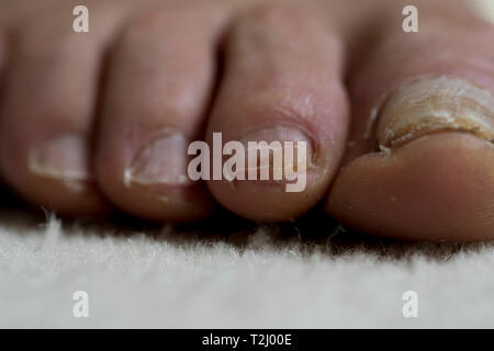 Stop foot nail fungus infection fungal bacteria Vector Image