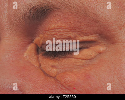 Xanthelasma patch Stock Photo