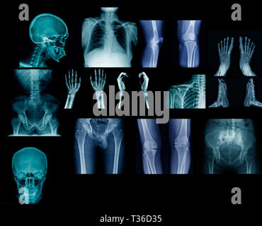 big collection x-ray image on black or dark background, hight quality of human anatomy by x-ray Stock Photo