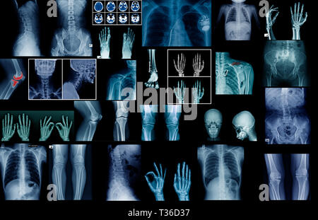 big collection x-ray image on black or dark background, hight quality of human anatomy by x-ray Stock Photo