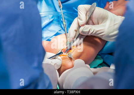 Group of orthopedic surgeons performing surgery on a patient arm Stock Photo