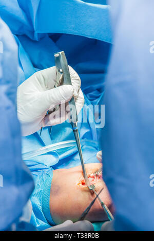 Group of orthopedic surgeons performing surgery on a patient arm Stock Photo