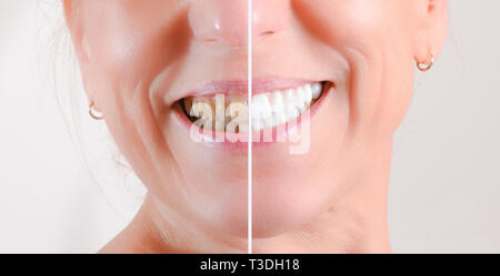 Concept of before and after treatment of cleaning and bleaching teeth on the teeth of a mature woman Stock Photo
