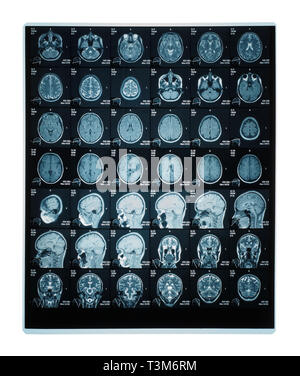 Real brain MRI slide of a young woman. Patient's and clinics names cloned out Stock Photo