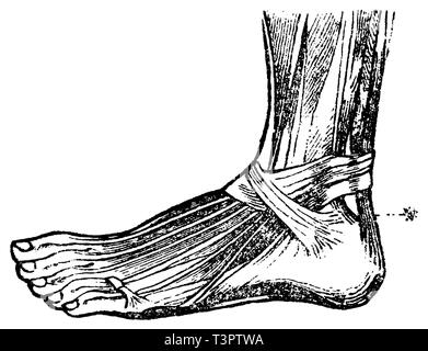 A device extension of the foot and flexion of the leg for tendon rupture,  of Achilles, vintage engraved illustration. Magasin Pi Stock Vector Image &  Art - Alamy