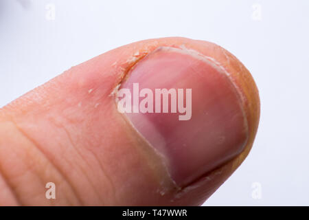 Man finger close up, dry cuticle, chapped skin. a finger of a man with the skin exfoliated around the nail Stock Photo