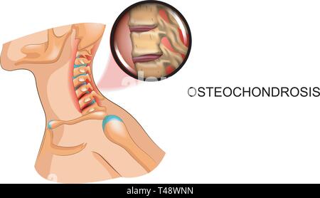 osteochondrosis c5 lábízületi betegségek kezelése