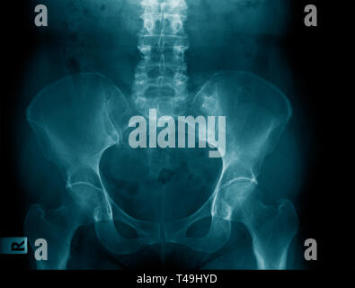 x-ray image show pelvic bone and part of lumbar spine Stock Photo