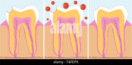 Three phase of caries treatment, vector illustration Stock Vector