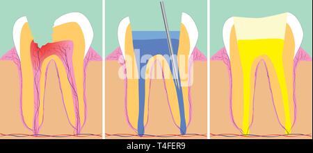 Three phase of dentistry, vector illustration Stock Vector