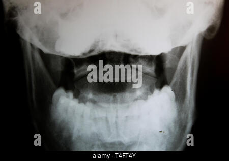 X-Ray image of skull with focus on head joints (Atlas and axis) Stock Photo