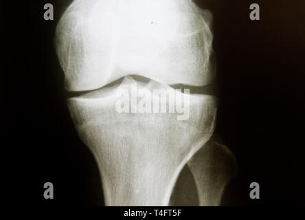 X-ray image of healthy regular knee with normal joint space (negative results) Stock Photo