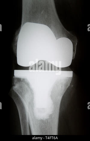 X-Ray image of knee with complete artificial joint replacement (Endoprosthesis) in case of arthrosis (joint degeneration) Stock Photo