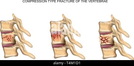 vector illustration of a compression type fracture of the spine Stock Vector