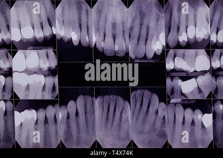 An X-ray of teeth, composited of every tooth showing crowns and filings to evaluate dental health or confirm identity Stock Photo
