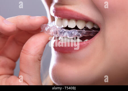Close-up Of A Woman's Hand Putting Transparent Aligner In Teeth Stock Photo