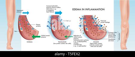 Main stages of edema inflammation illustrated in medical diagram. Stock Vector