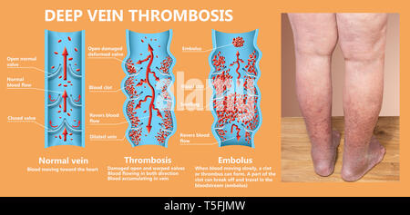 thrombosis. From Normal blood flow to Blood clot formation Stock Photo