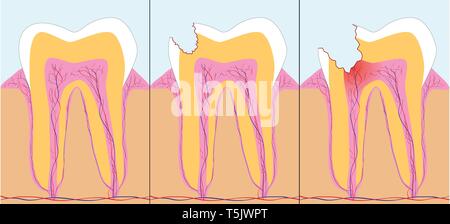 Three phase of caries, vector illustration Stock Vector