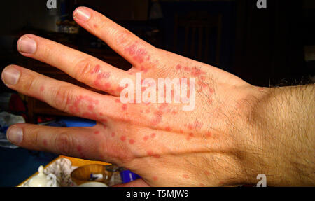 Midge bites on hand Stock Photo - Alamy