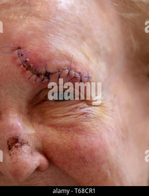Sydney, Australia - April 16 2019: Elderly woman's wound above the eye from a fall. 16 stitches and infection showing. Stock Photo
