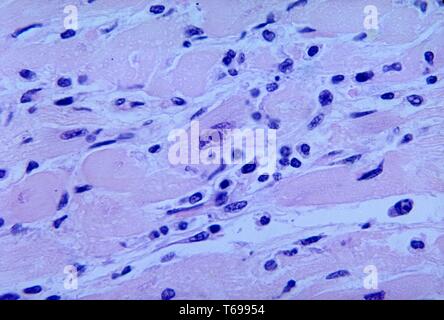 This micrograph reveals an intranuclear inclusion body in a heart section from a patient with diphtheria-related myocarditis, 1965. In approximately 25 percent of patients with diphtheria, a toxin produced by Corynebacterium diphtheria bacteria causes inflammation of the myocardium, which is the most common and most worrisome complication. Image courtesy CDC/Dr. Martin Hicklin. Stock Photo