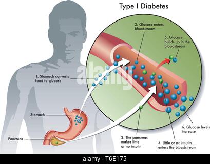 Medical illustration of the symptoms of type 1 diabetes Stock Vector