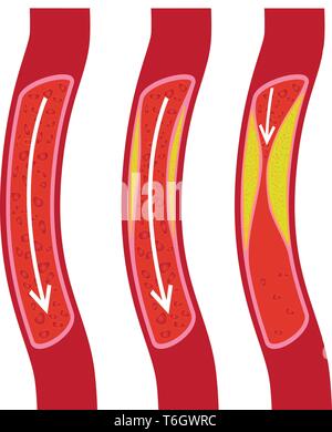 blocked blood vessel artery with cholesterol buildup cells creating ...