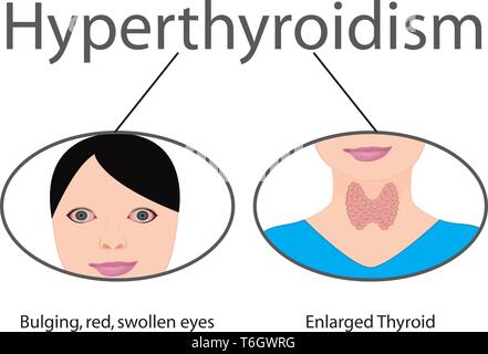 Goiter. Thyroid Disease. Endocrine Disfunction Vector Illustration On A 