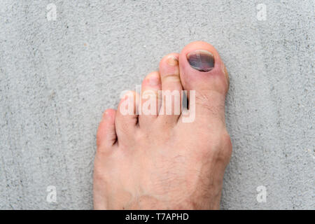 Why do I have a black toenail and how can I treat it? - 220 Triathlon